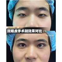 李洋双眼皮整形