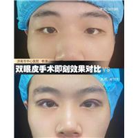 李洋双眼皮整形