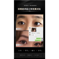 李洋双眼皮整形