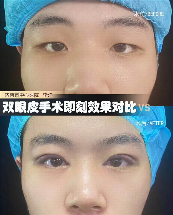 李洋双眼皮整形
