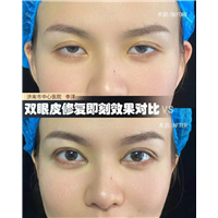 李洋双眼皮整形