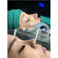 厦门鼻整形修复医生
