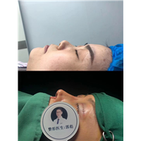 厦门隆鼻整形医生