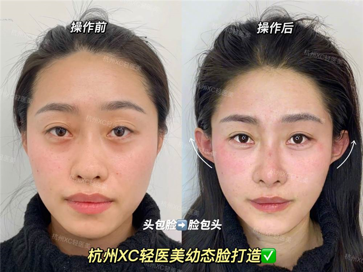 我的下颌角外翻想恢复正常怎么办