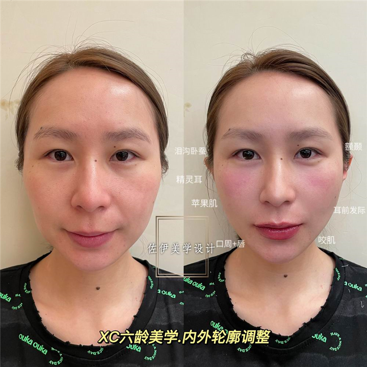 佐伊