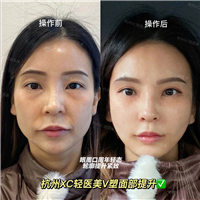 从下颌角去外板效果图了解长曲线下颌骨必须劈外板吗