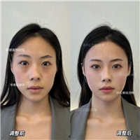长沙磨骨专家