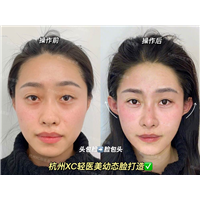 我的下颌角外翻想恢复正常怎么办