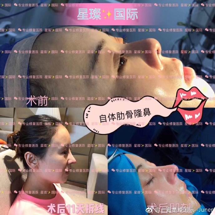 上海星璨鼻综合整形效果 