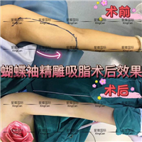 上海星璨吸脂减肥整形医院 