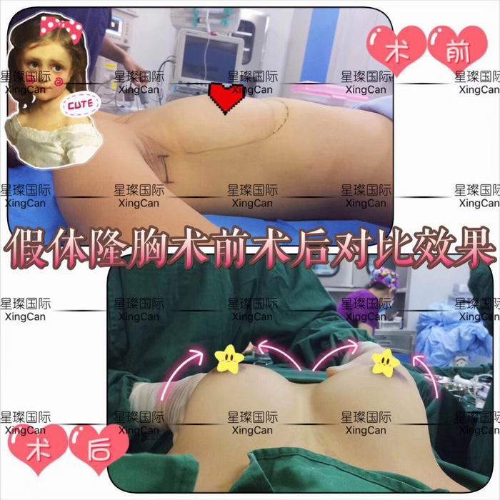 上海假体丰胸手术整形手术 