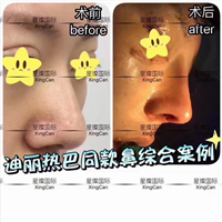 迪丽热巴同款鼻综合整形医院 