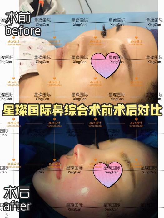 上海鼻综合整形哪家好 