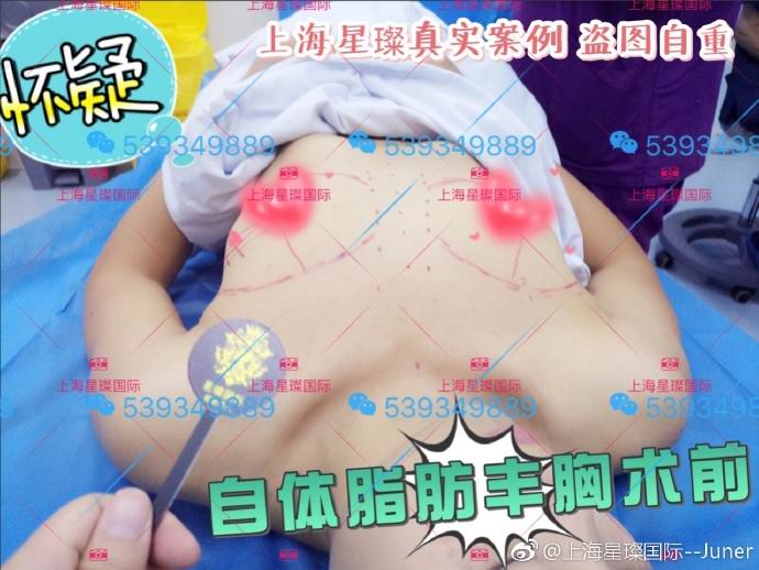 上海星璨自体脂肪丰胸整形 