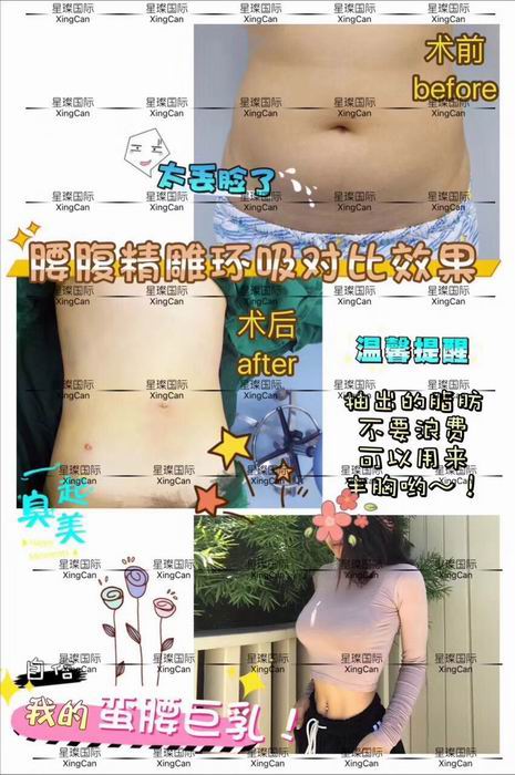 上海腰部吸脂整形医院 