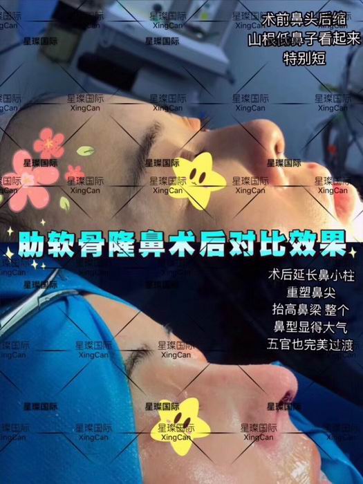 上海软肋骨隆鼻整形医院 