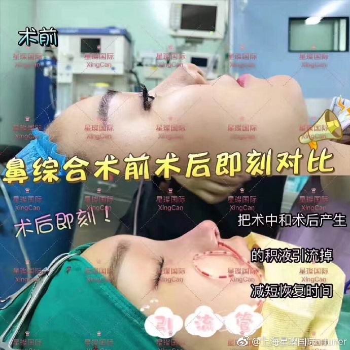 上海鼻部综合整形医院 