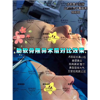 上海软肋骨隆鼻整形医院 