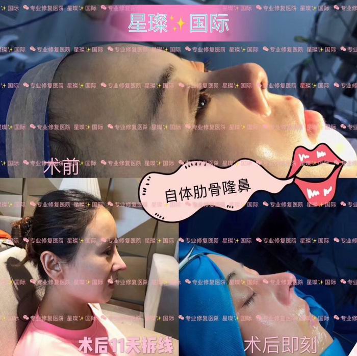 上海自体肋骨隆鼻整形医院 