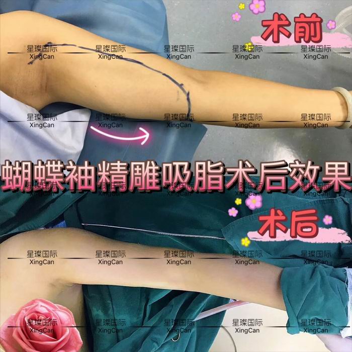 上海星璨吸脂减肥整形医院 