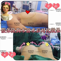 上海假体丰胸手术整形手术 