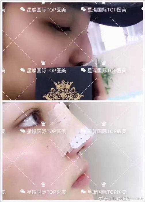 上海星璨鼻综合整形医院 