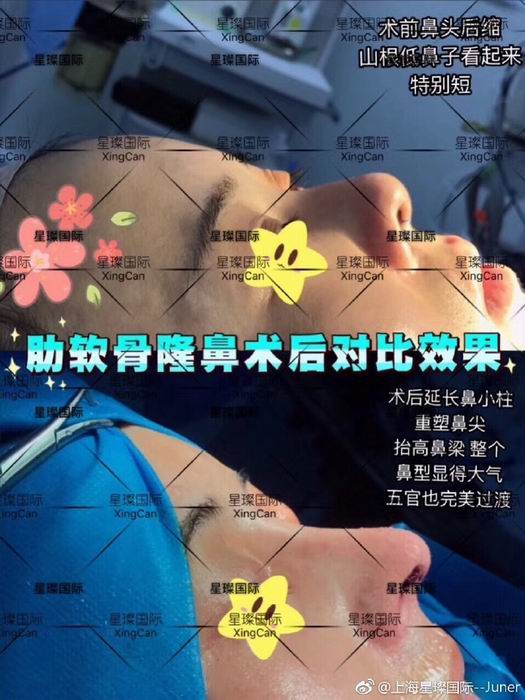 上海鼻综合整形哪家好 