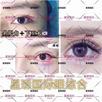 上海星璨眼部整形效果怎样 