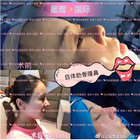 上海星璨鼻综合整形效果 
