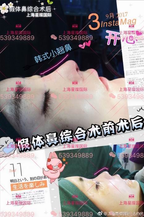 上海假体隆鼻整形医院 