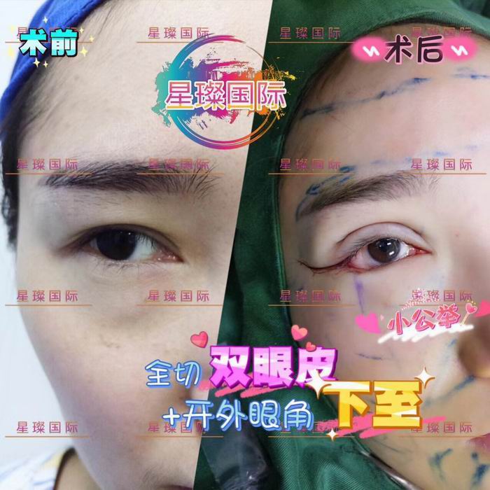 上海眼综合整形医院哪家好 