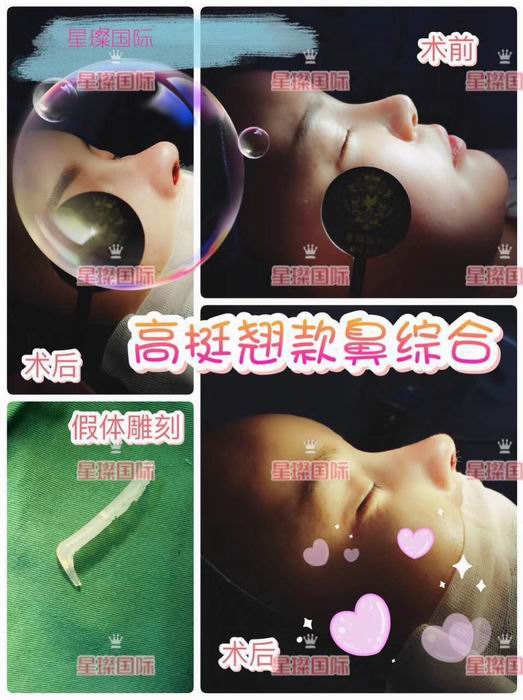 上海哪里做鼻综合整形好 