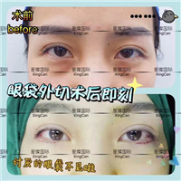 上海去眼袋整形医院哪家好 