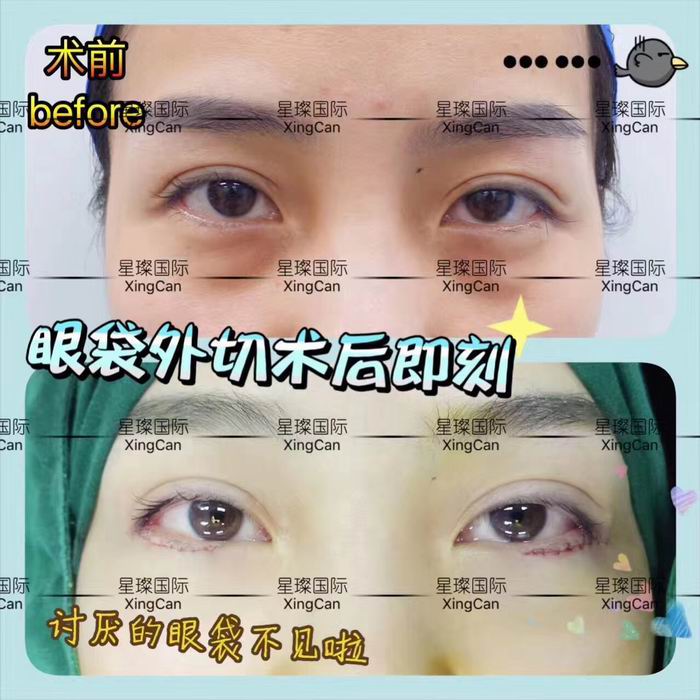 上海去眼袋整形医院哪家好 