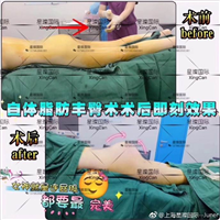 上海正规丰臀整形医院 