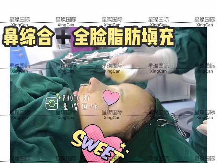 上海鼻综合整形医院,全脸脂肪填充整形 