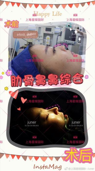 上海肋骨鼻综合整形医院 