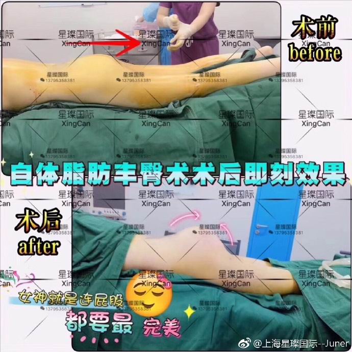 上海正规丰臀整形医院 