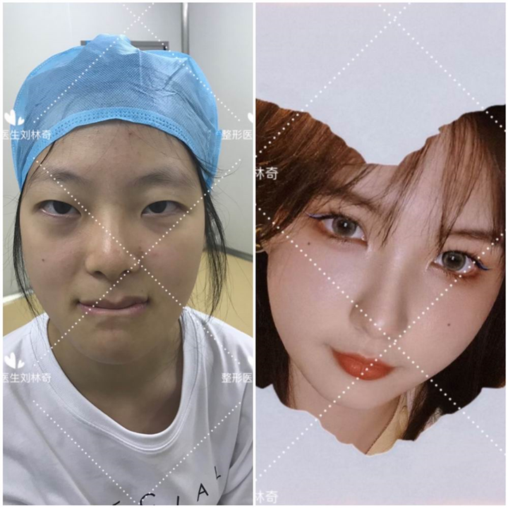 刘林奇双眼皮案例