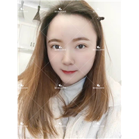 刘林奇双眼皮案例