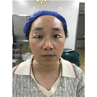 刘林奇修复