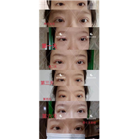 刘林奇双眼皮案例