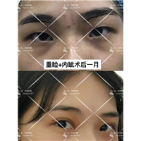 刘林奇双眼皮案例