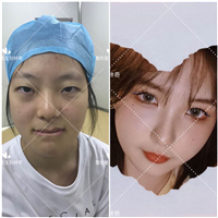 刘林奇双眼皮案例