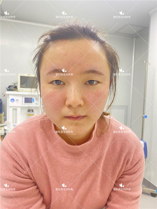 刘林奇双眼皮案例