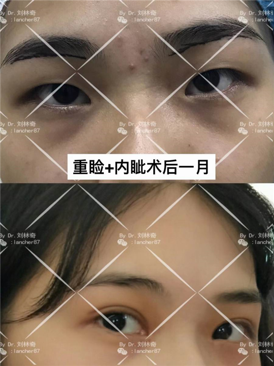 刘林奇双眼皮案例