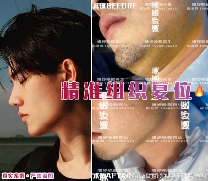 长沙面部精准组织复位案例