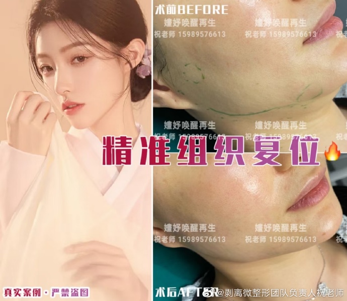 长沙面部精准组织复位案例