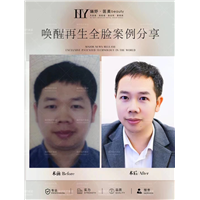 唤醒再生术全脸案例