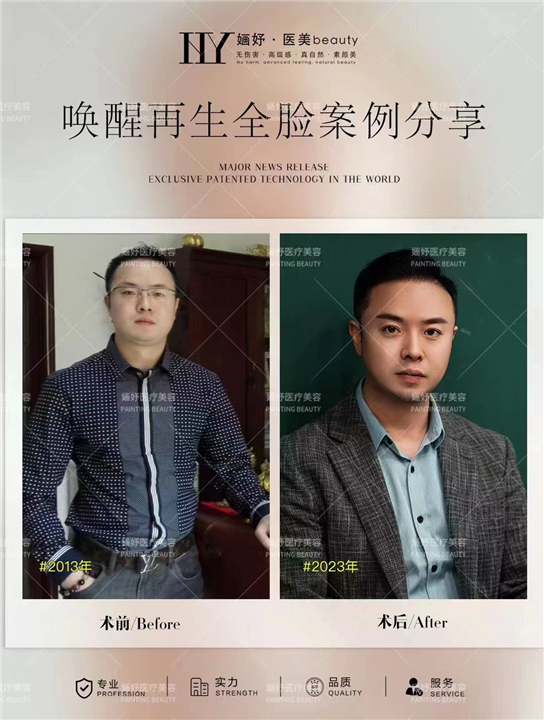唤醒再生术全脸案例